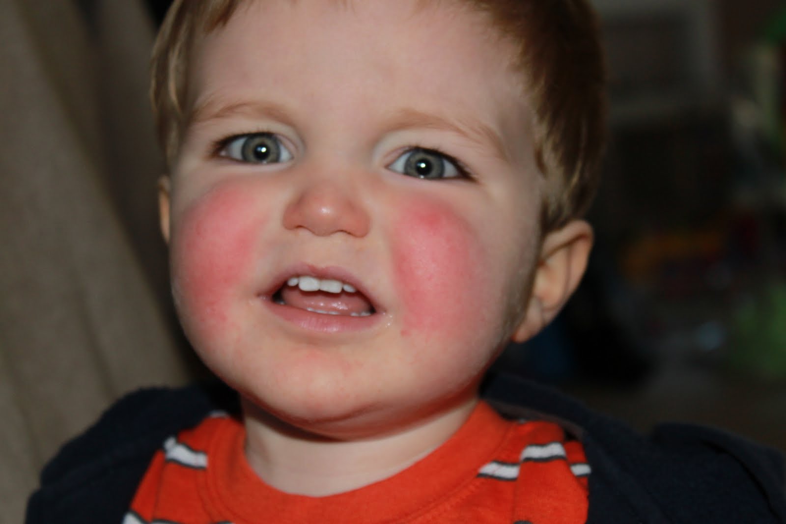 Slapped Cheek Disease