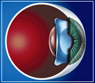 [effective+for+thin-flap+LASIK.jpg]