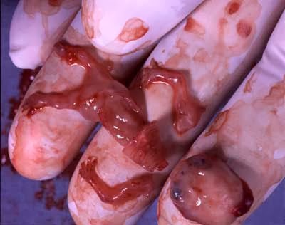 ABOLICIÓN DEL ABORTO: ATENTADO CONTRA LA HUMANIDAD