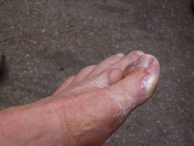 blister on feet