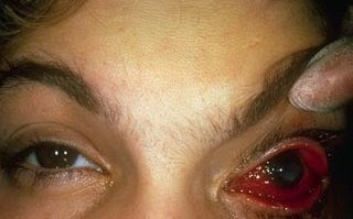 gonorrhea eye pictures