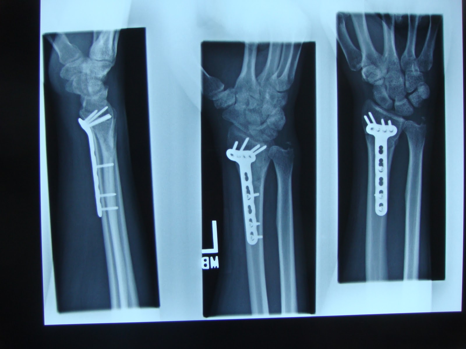 awildermode Titanium Plate