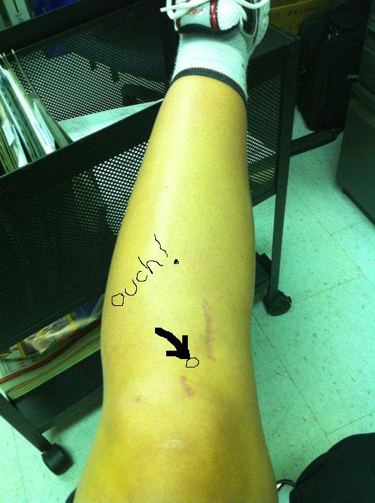 Pain below knee cap squatting