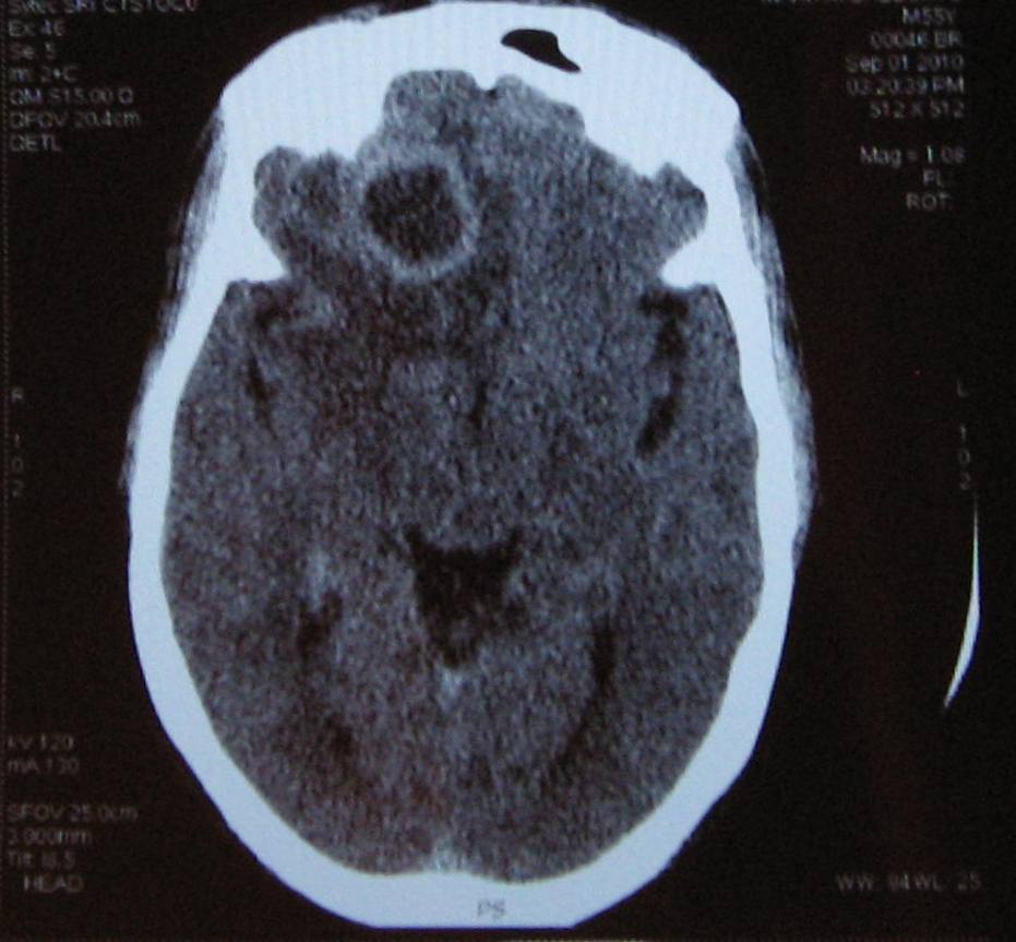 head abscess