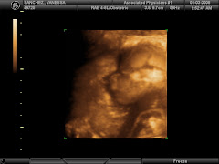 In the womb