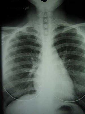 What is Mesothelioma Disease