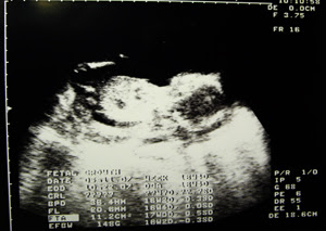 【Baby十七週時的超音波照片】