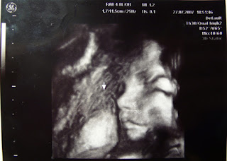 【醫生說超音波還沒有「防手震」，所以baby在拍4D照片時因為頭部正在活動，所以眼睛嘴巴的部份有點拉長了。】