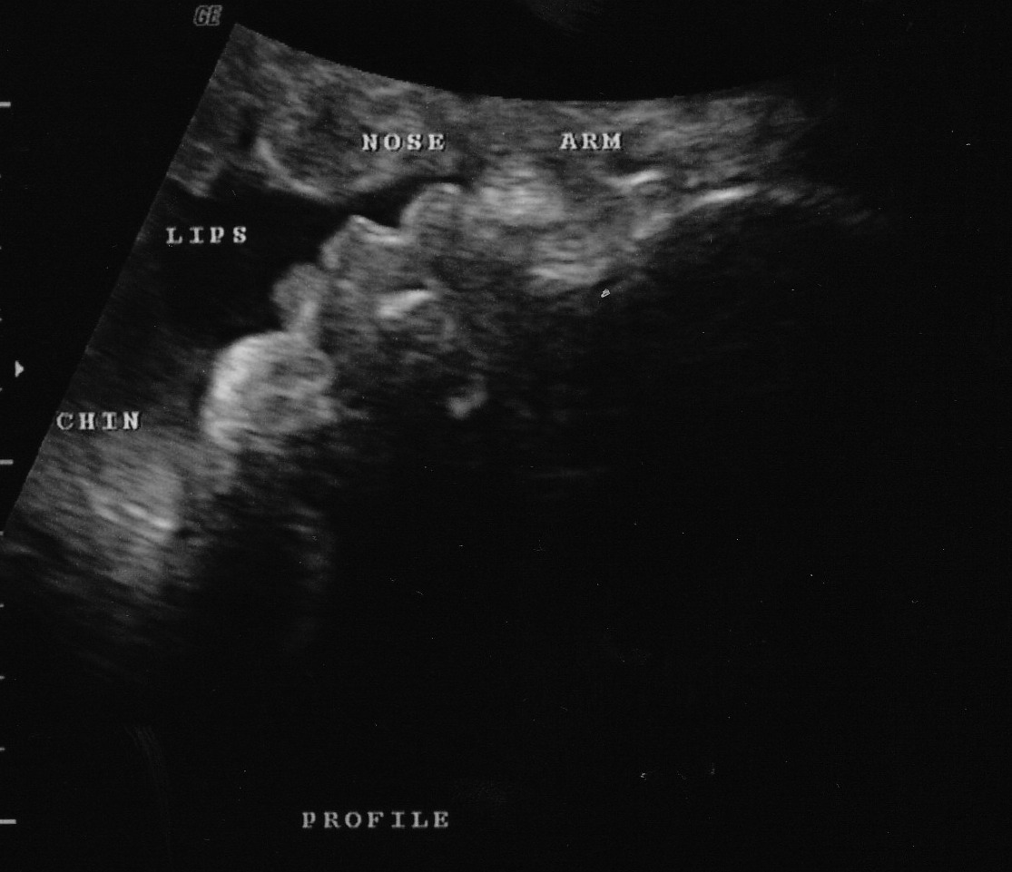 Hair On Ultrasound