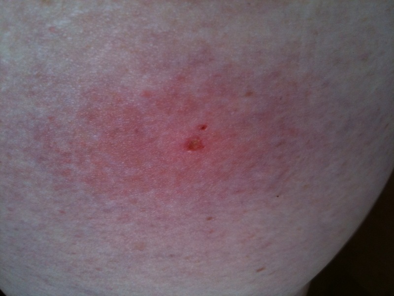 What do european earwigs eat, spider bites pictures florida, what do