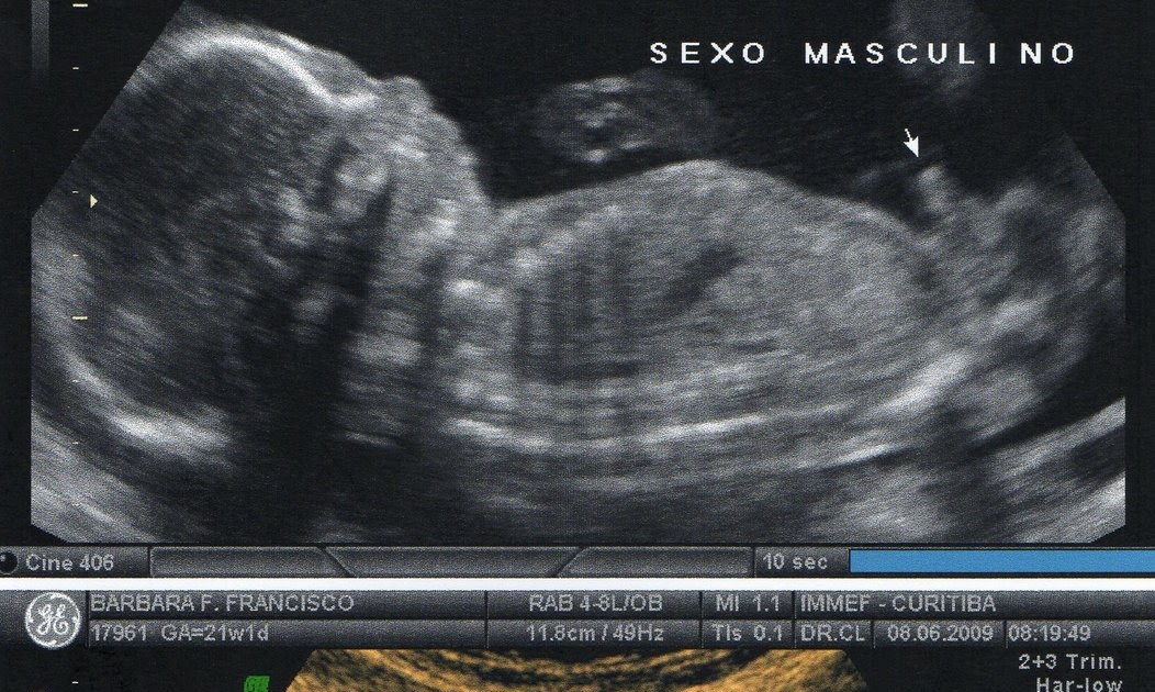 O começo de uma nova vida... (The rising of a new life...) Ultrasom