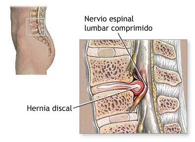 La hernia de los discos intervertebrales del departamento lumbar de la columna vertebral