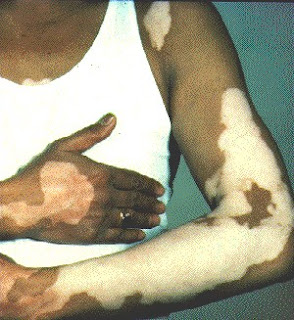 vitiligo disease image