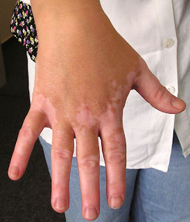 vitiligo