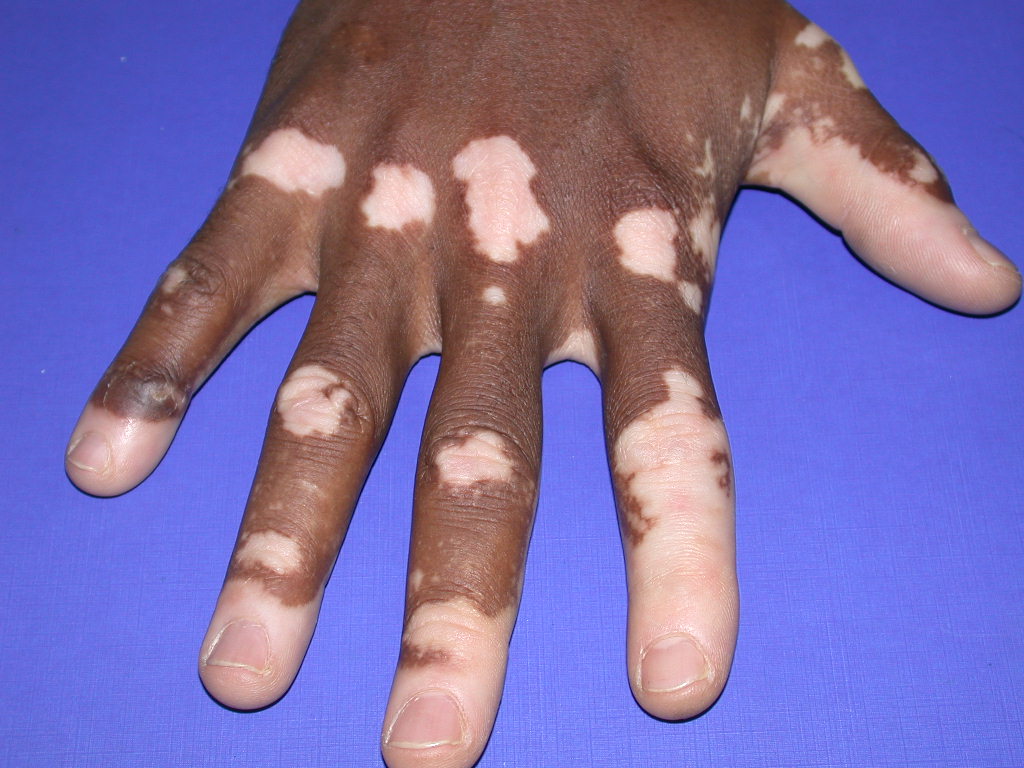 el Vitiligo tiene cura el Vitiligo tiene cura