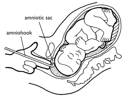 Amniotic Sack
