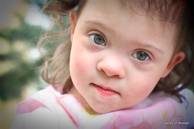 down syndrome features