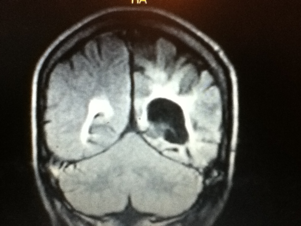HIV encephalopathy and AIDS dementia complex