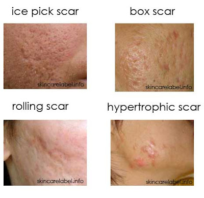Watch Different Treatments for Different Type of Pimples in Hindi video Watch Different Treatments for Different Type of Pimples in Hindi video