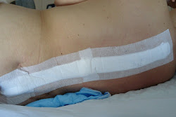 There is the 42" long incision! Yikes!