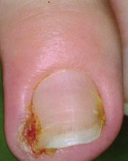 El hongo de las uñas curar el foro