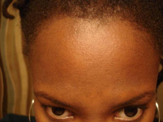 accutane on african american skin