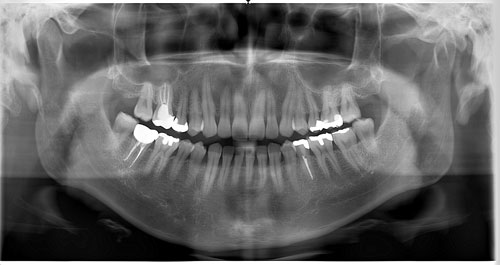 Dental Volumetrik Tomografi Nasil Cekilir Avantajlari Ve Fiyatlari
