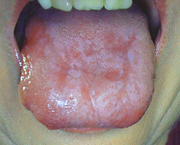 Pictures Of Thrush On Back Of Tongue