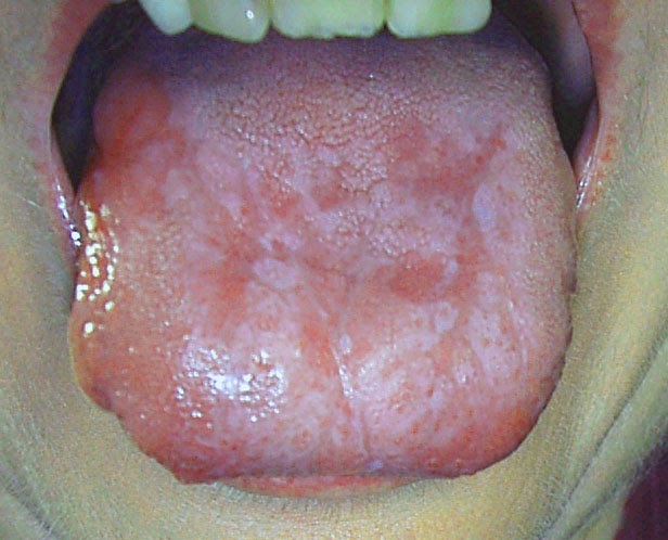 anal lichen planus women of commercials nude