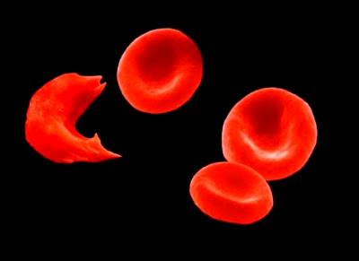 anemia de células falciformes