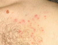 SOLUTIONS POUR SE DEBARRASSER DES POILS INCARNES ... SOLUTIONS POUR SE DEBARRASSER DES POILS INCARNES ...