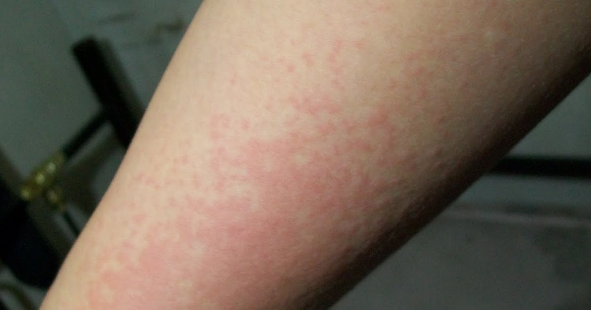 My Happily Ever After I Have Dengue?