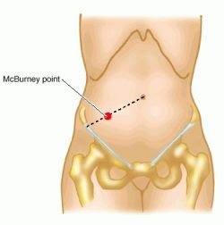 McBurney's+Incision at the junction of the lateral and middle one thirds of a line from ...