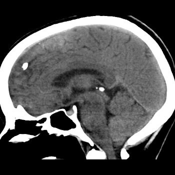 basal ganglia calcification,possible fahrs syndrome