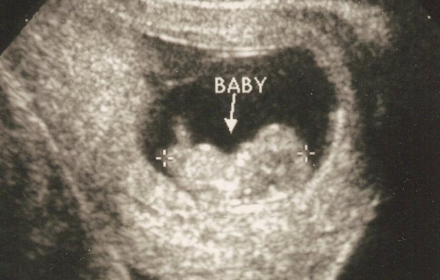[Baby+Ultrasound+EightWeeks.jpg]