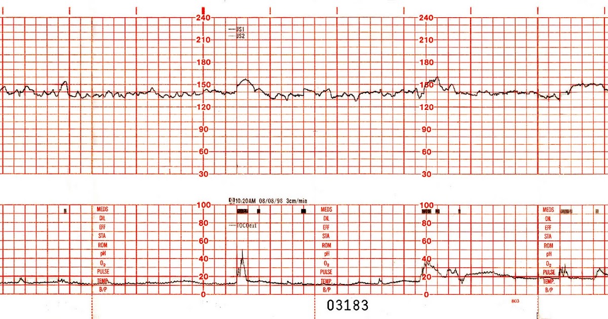 RBMC OB&GYN SUPPLEMENTAL INFO Interpertation of NST