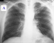 [180px-Pneumonia_x-ray.jpg]