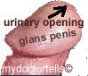 image showing circumcised penis. Glans penis seen. No foreskin prepuce