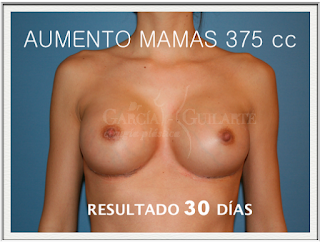 aumento_pecho_mamas_cirujano_plastico