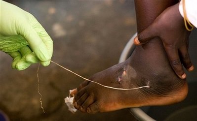 [Guinea+Worm+in+Foot.jpg]