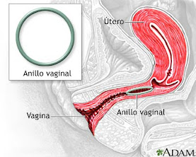 Anillo vaginal