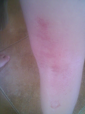 tropicalask Toddler heat toddler heat rash pictures. tropicalask Toddler heat