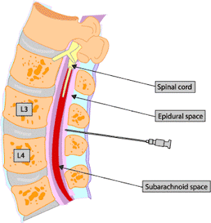epidural site pain years later epidural site pain years later