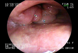 HIPERPLASIA FIBROSA INFLAMATORIA DE LARINGE