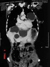 HIDATIDOSIS PULMONAR Y HEPÁTICA