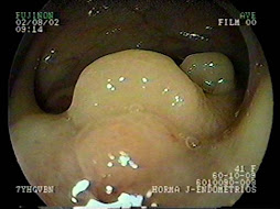 2.- ENDOMETRIOSIS COLORRECTAL