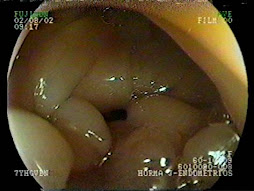 3.- ENDOMETRIOSIS COLORRECTAL