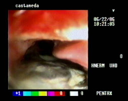 3.- DISFAGIA Y ARTRODESIS CERVICAL