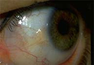 Pinguecula Eye