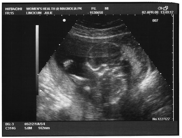 18 Week Ultrasound